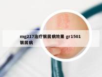 mg217治疗银屑病效果 gr1501 银屑病