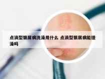 点滴型银屑病洗澡用什么 点滴型银屑病能搓澡吗