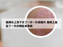 胳膊从上到下长了一片一片癣图片 胳膊上面起了一片的摸起来像癣