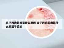 鼻子两边起癣是什么原因 鼻子两边起癣是什么原因导致的