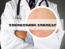 生物制剂能控制病情吗 生物制剂能治疗