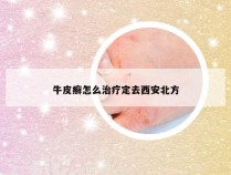 牛皮癣怎么治疗定去西安北方