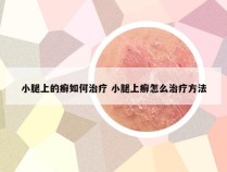 小腿上的癣如何治疗 小腿上癣怎么治疗方法