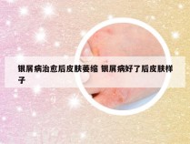 银屑病治愈后皮肤萎缩 银屑病好了后皮肤样子