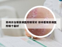 郑州诊治银屑病医院哪家好 郑州看银屑病医院哪个最好