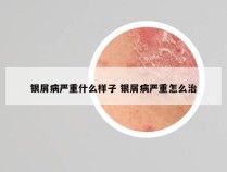 银屑病严重什么样子 银屑病严重怎么治