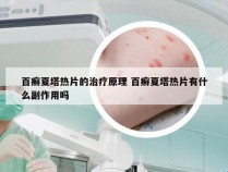 百癣夏塔热片的治疗原理 百癣夏塔热片有什么副作用吗