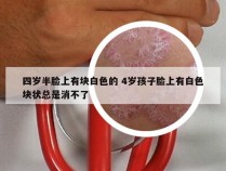 四岁半脸上有块白色的 4岁孩子脸上有白色块状总是消不了