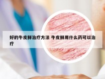 好的牛皮鲜治疗方法 牛皮鲜用什么药可以治疗