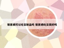 银屑病可以吃豆制品吗 银屑病吃豆类好吗