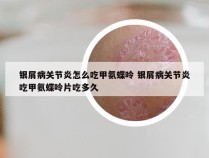 银屑病关节炎怎么吃甲氨蝶呤 银屑病关节炎吃甲氨蝶呤片吃多久