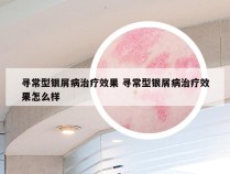 寻常型银屑病治疗效果 寻常型银屑病治疗效果怎么样