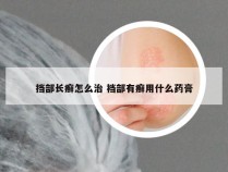 挡部长癣怎么治 裆部有癣用什么药膏