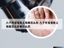 八个月宝宝身上有癣怎么办 八个月宝宝身上有癣怎么办用什么药