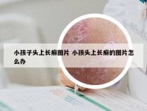 小孩子头上长癣图片 小孩头上长癣的图片怎么办