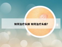 如何治疗头鲜 如何治疗头癣?