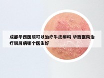 成都华西医院可以治疗牛皮癣吗 华西医院治疗银屑病哪个医生好