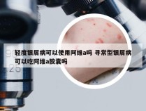 轻度银屑病可以使用阿维a吗 寻常型银屑病可以吃阿维a胶囊吗