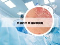 银屑的图 银屑癣病图片