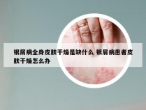 银屑病全身皮肤干燥是缺什么 银屑病患者皮肤干燥怎么办