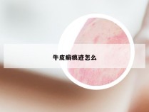 牛皮癣痕迹怎么