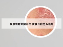 皮肤有藓如何治疗 皮肤长藓怎么治疗