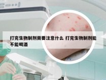 打完生物制剂需要注意什么 打完生物制剂能不能喝酒