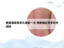 银屑病皮肤多久更新一次 银屑病正常多长时间好