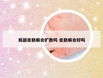 局部皮肤癣会扩散吗 皮肤癣会好吗