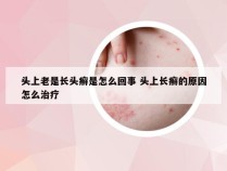 头上老是长头癣是怎么回事 头上长癣的原因怎么治疗