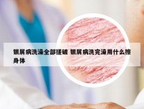 银屑病洗澡全部搓破 银屑病洗完澡用什么擦身体