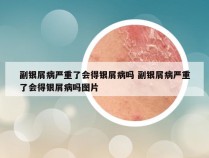 副银屑病严重了会得银屑病吗 副银屑病严重了会得银屑病吗图片