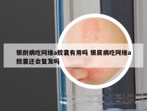 银削病吃阿维a胶囊有用吗 银屑病吃阿维a胶囊还会复发吗