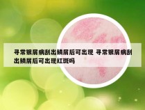 寻常银屑病刮出鳞屑后可出现 寻常银屑病刮出鳞屑后可出现红斑吗