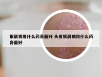 银屑病用什么药膏最好 头皮银屑病用什么药膏最好