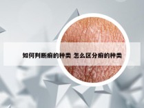 如何判断癣的种类 怎么区分癣的种类