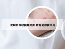 皮癣的症状图片图库 皮藓的症状图片