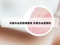 长春华山皮肤病莆田 长春华山皮肤科