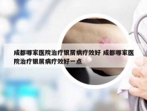 成都哪家医院治疗银屑病疗效好 成都哪家医院治疗银屑病疗效好一点