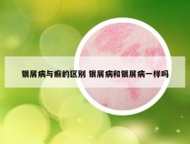 银屑病与癣的区别 银屑病和银屑病一样吗