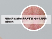 用什么药能控制白癜风不扩散 吃什么药可以控制白斑