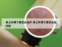 身上长满了癣怎么治疗 身上长满了癣怎么治疗好