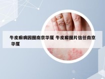 牛皮癣病因图南京华厦 牛皮廨图片信任南京 华厦