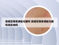 脓疱型银屑病能吃醋吗 脓疱型银屑病能吃醋吗有影响吗