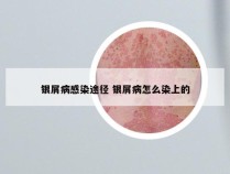 银屑病感染途径 银屑病怎么染上的