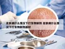 皮肤病什么情况下打生物制剂 皮肤病什么情况下打生物制剂最好