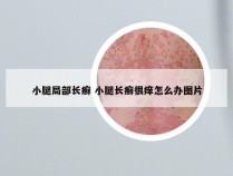 小腿局部长癣 小腿长癣很痒怎么办图片