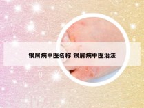 银屑病中医名称 银屑病中医治法