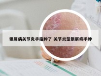 银屑病关节炎手指肿了 关节炎型银屑病手肿