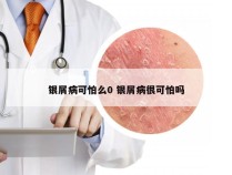 银屑病可怕么0 银屑病很可怕吗